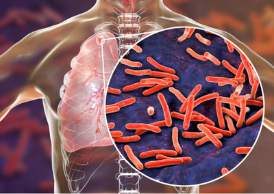 Tuberculosis: una mortífera enfermedad que se puede prevenir y curar
